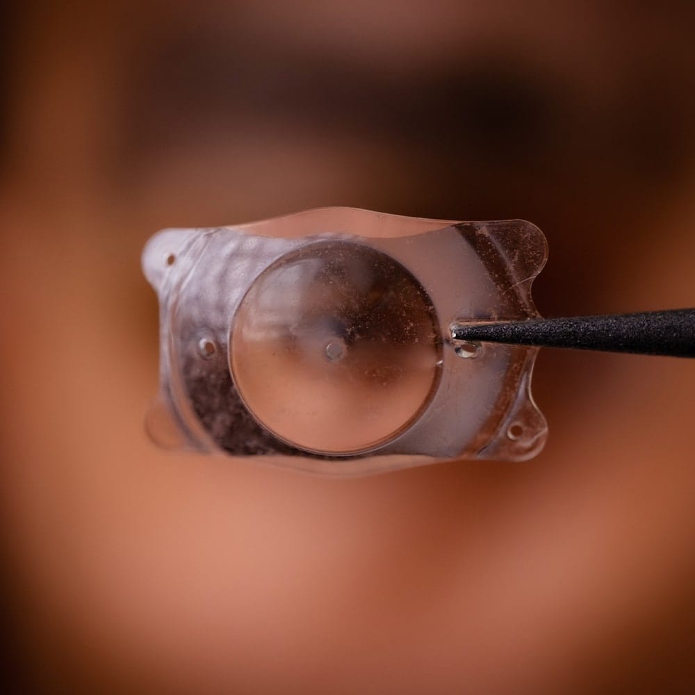 implant phake icl dr nathalie butel chirurgien ophtalmologue specialiste chirurgie refractive cataracte oculoplasticien paris