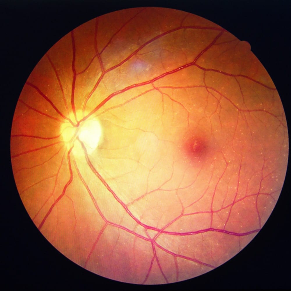retinopathie diabetique traitement dr nathalie butel chirurgien ophtalmologue specialiste chirurgie refractive cataracte oculoplasticien paris
